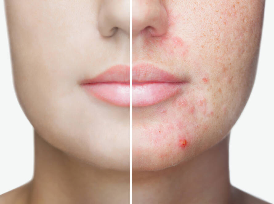 A young girl with a problem skin. Photo before and after treatment for acne. A young girl with a problem skin. Photo before and after treatment for acne.